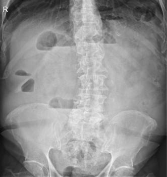 Figure 1 Upright abdominal radiograph Upright abdominal radiograph shows a diffuse absence of bowel air with a few
