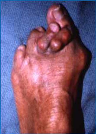 Rigid Foot Deformities Any deformity that could not be reduced
