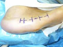remained healed 10 Subjects with DM All UT DM Foot Risk Category 3 All with pre-operative AJ DF <10 degrees TAL Performed Peak plantar