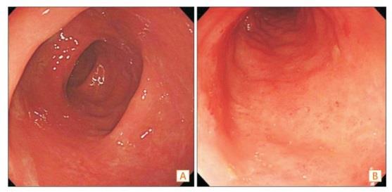Initial colonoscopic and pathologic findings