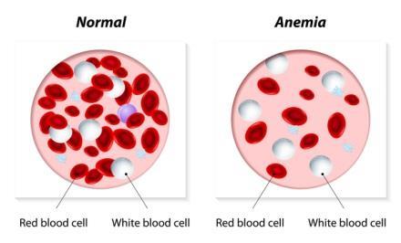 Anemia: Anemia is a disease characterized by a low red blood