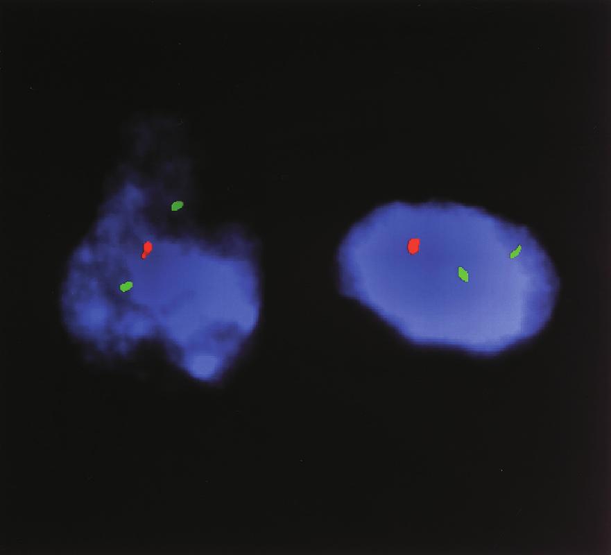 (a) Non-dividing nuclei of brain tumour cells of patient No.