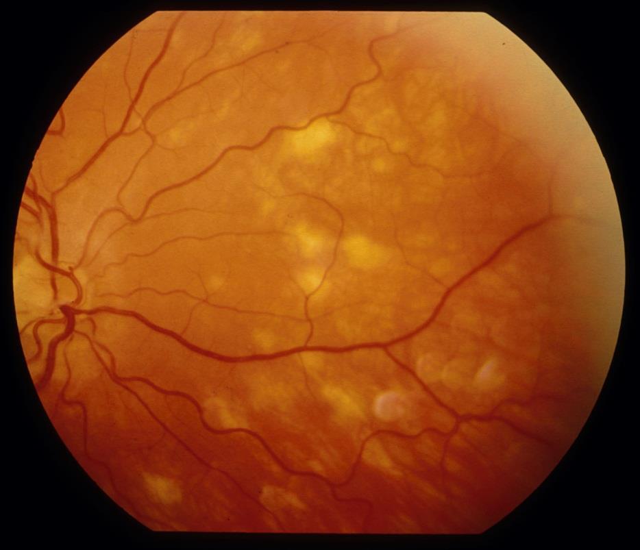 Choroid and retina Typical -