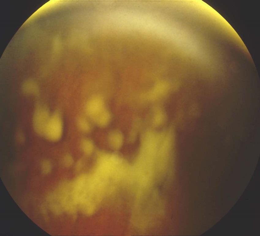 The vitreous in sarcoidosis 15% of sarcoid