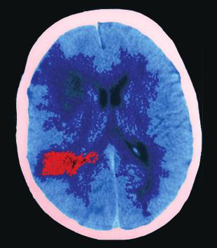Epilepsy: problems of diagnosis and recommended treatment Nicola Cooper MRCP and Morgan Feely MD, FRCP, FRCP(I) VM Our series Prescribing in gives practical advice for successful management of the