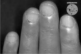 Dilated nailfold vessels Management of Raynaud s phenomenon Avoid the cold; keep