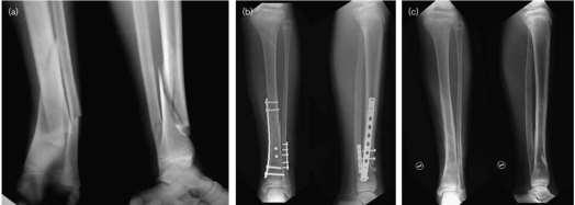 tissues at the fracture site