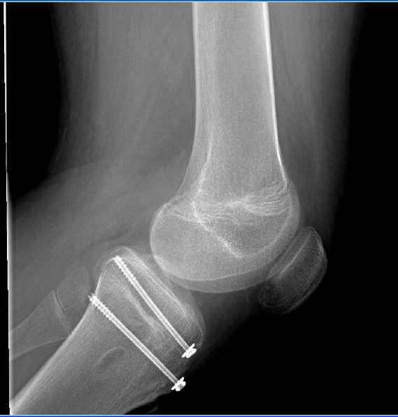 Tibial Tubercle Fractures Big incision Large soft