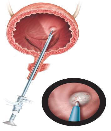 Botulinum toxin injections to relax the bladder Botulinum toxin type A injected into the detrusor muscle under cystoscopic guidance appears to be a highly promising treatment for intractable detrusor