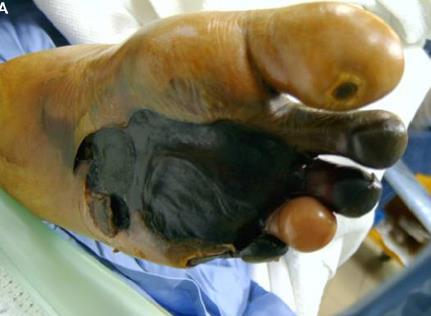 Prospective study of 32 amputations for foot gangrene 24 LisFranc, 8 Chopart s 8