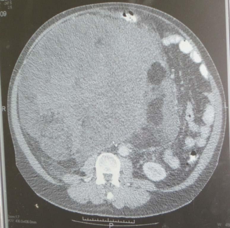 Case presentation: Retroperitoneal liposarcoma Large retroperitoneal sarcoma extending from the liver to the pelvis displacing right sided structures to the