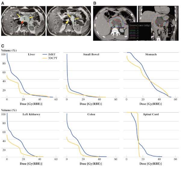 Radiotherapy with Proton Beam N=28 patients treated with IMRT or proton therapy