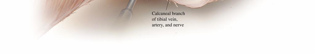 The needle from the suture is passed through a subcutaneous tunnel to the lateral aspect of the hindlimb where it is