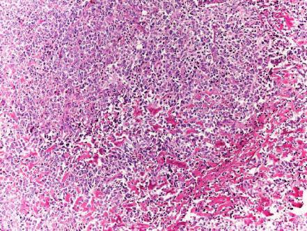 Discussion Metaplastic carcinoma is a general term referring to a heterogeneous group of breast tumors characterized by an intimate admixture of Figure 2.