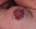 Infantile Hemangioma Types Deep «cavernous» Hemangioma involve the deep dermis and subcutis bluish to