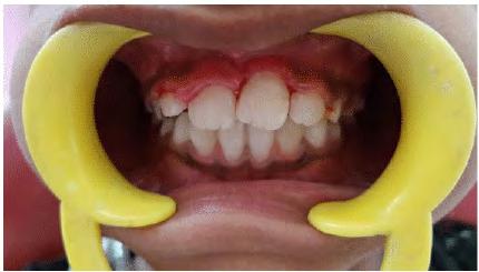 412 Figure 5 Case 2 A 13 year old girl (Figure 6-10) reported to the Department of Pedodontics and Preventive Dentistry, with the chief complaint of