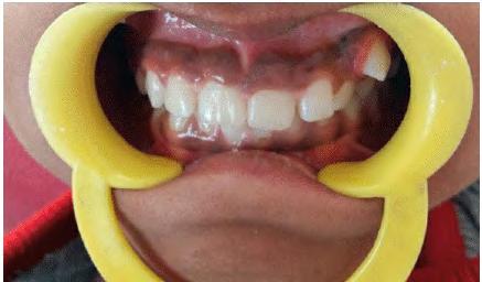 Extra oral examination presented a symmetrical face with no other relevant cause for the malposed tooth.
