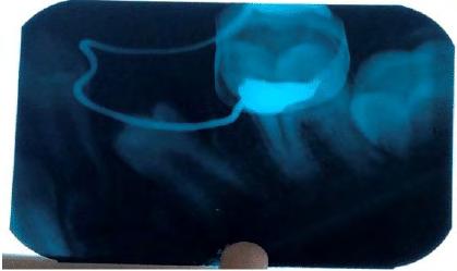 On intra-oral examination, a grossly carious deciduous second molar (85) was noted and the intraoral periapical radiograph (IOPA) revealed an ectopically erupting 45