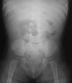 Turk J Gstroenterol 2018; 29: 221-5 Shhrmin et l. Colonic volvulus in childhood ptient lso presented with severe nuse nd vomiting. The ptient s pin ws continuous; thus, he hd to e sedted.
