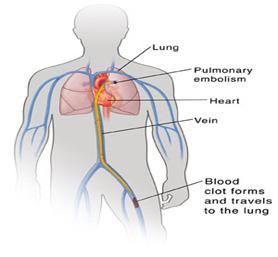 Deep Vein Thrombosis (DVT) A DVT is a blood clot in a leg or arm vein.