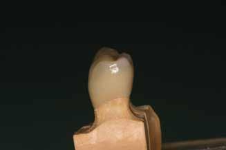 putty and wash impression, of the existing tooth or restoration.