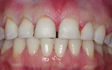 and chipping of the incisal margins of the front teeth together with loss of volume.