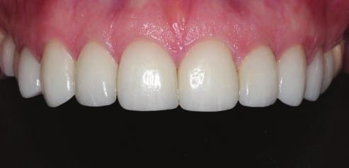 Cementation was performed under local anaesthesia using Optragate, and bite block isolation, retracting cord (sutures) Teflon tape, silane, bond and Relyx veneer cement (translucent shade).