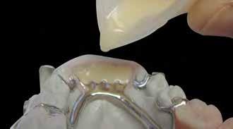 Telescopic restorations Clasp-retained denture