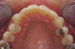 had worn the edges of his teeth badly, allowing absorption of stain through the tips (Figure 3).