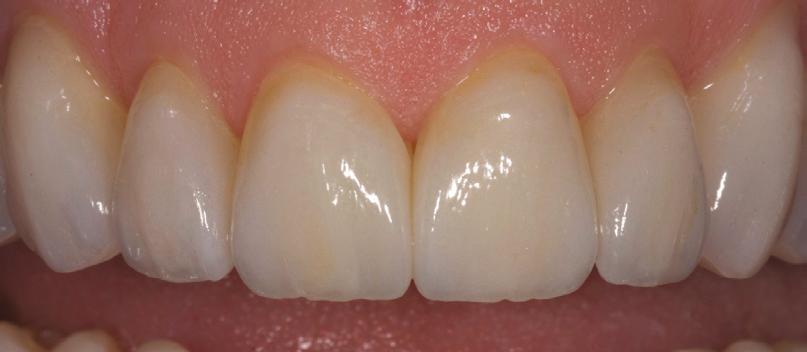 Our plan was then to perform anterior alignment of the teeth with simultaneous whitening and then to reassess the smile design and occlusal function afterwards to realign, then design.