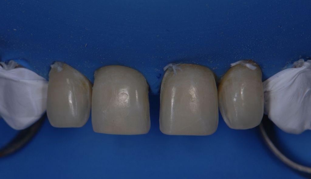15 A rubber dam was placed for adequate isolation. Teflon tape was placed mesial to the canines for them not to get etched.