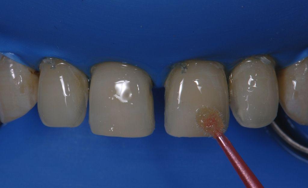17 Bonding agent( Single Bond, 3M Espe) was applied to the teeth according to the manufactures instructions.