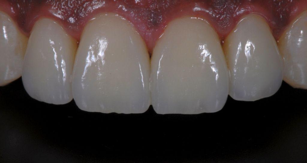 18 Four Feldspathic ceramic veneers fabricated using the refractory die technique, cemented with light cure resin cement(relyx Veneer Cement, 3M Espe).