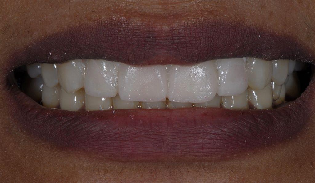3 The patient is given home bleaching as for two weeks with 10% Carbamide Peroxide to be carried out for 2 hours a day. This makes the tooth shade lighter. For every colour change desired one needs 0.
