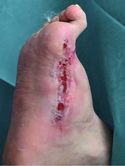 ASSESS Perform a full holistic assessment of the patient, the diabetic foot and the wound, and carry out a vascular assessment. Complete the checklist. Is debridement appropriate for this wound?