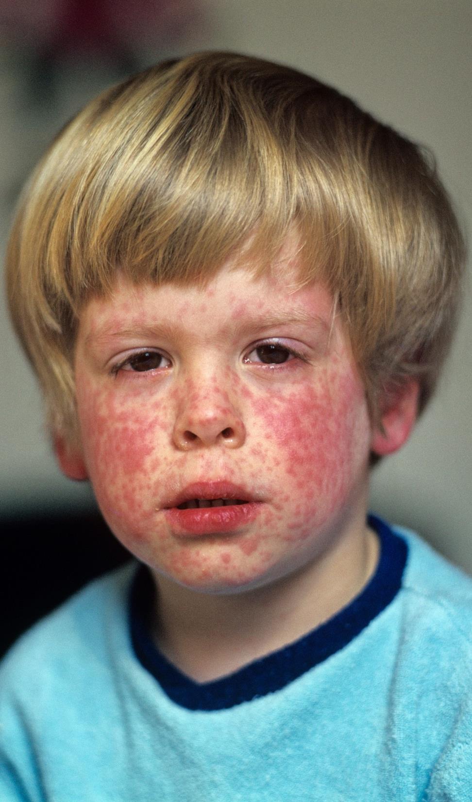 Supplementation in MEASLES Measles & Vitamin A Measles, a viral infection, infects and damages
