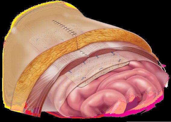 Ventral hernia repair The Biodesign