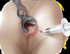 ANAL FISTULA REPAIR 1. Place a draining seton if any signs of sepsis or infection are present, and allow the tract to mature and stabilize for six to eight weeks before you place the plug.
