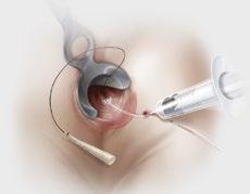 Blind-pass technique: Pull the plug, narrow end first, into the fistula tract until you feel slight resistance. Affix the plug by using a 2-0 long-term absorbable suture on a UR6 or comparable needle.