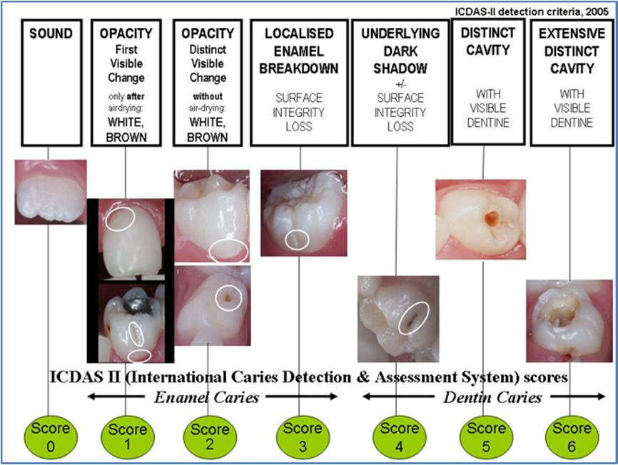 Figure 2: ICDAS II lesion ranking Research has shown that ICDAS presents good reproducibility and accuracy for in vitro and in vivo detection of primary caries lesions at different stages of the