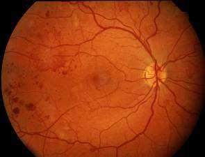 (comprehensive eye examination