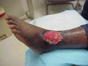 Principle #6 Is the wound and/or surrounding area edematous or