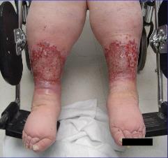 Many wounds have associated edema beyond the inflammatory phase