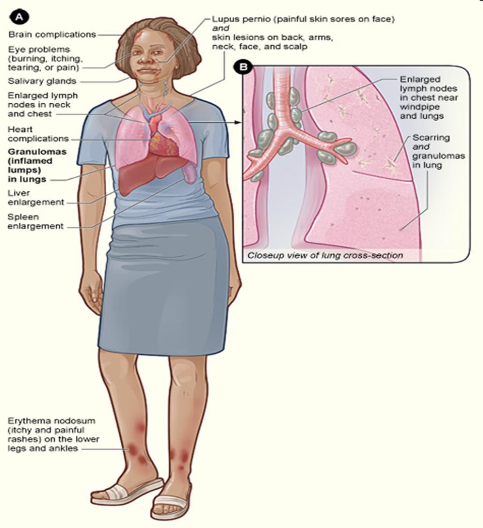 Tuberculosis and sarcoidosis are chronic systemic diseases