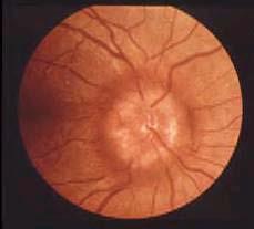 sarcoidosis, which includes the ocular presentations,