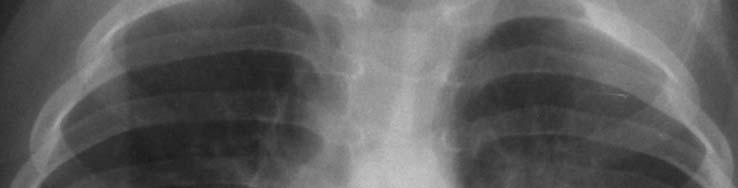 Lymphadenopathy in PTB- Complications Airway compromise Extrinsic compression Obstructive