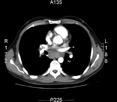 CT chest Mediastinal