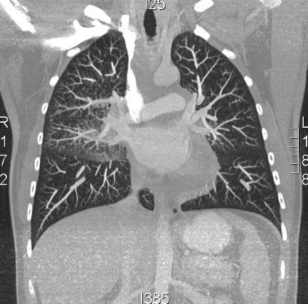 CT chest Focal pulmonary ground-glass and