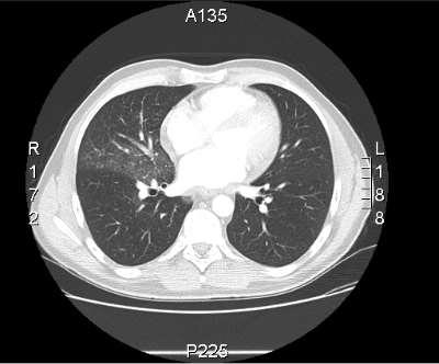 CT chest Focal pulmonary ground-glass and