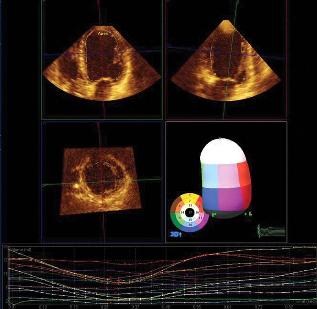 3-Dimensional LV Volume Measurement Example of three-dimensional (3D) left ventricular (LV) volumes generated by post-processing of a real-time threedimensional echocardiography data set, acquired in